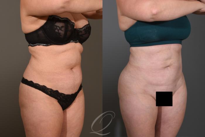 Liposuction Case 414 Before & After Right Oblique | Serving Rochester, Syracuse & Buffalo, NY | Quatela Center for Plastic Surgery