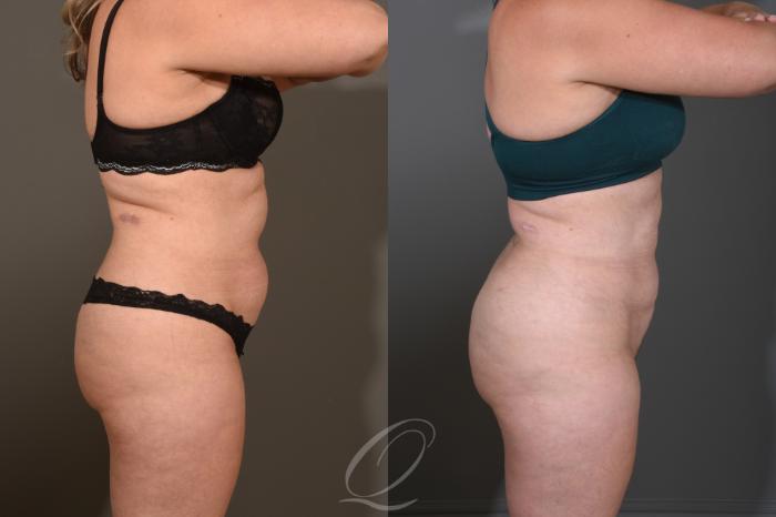 Liposuction Case 414 Before & After Right Side | Serving Rochester, Syracuse & Buffalo, NY | Quatela Center for Plastic Surgery