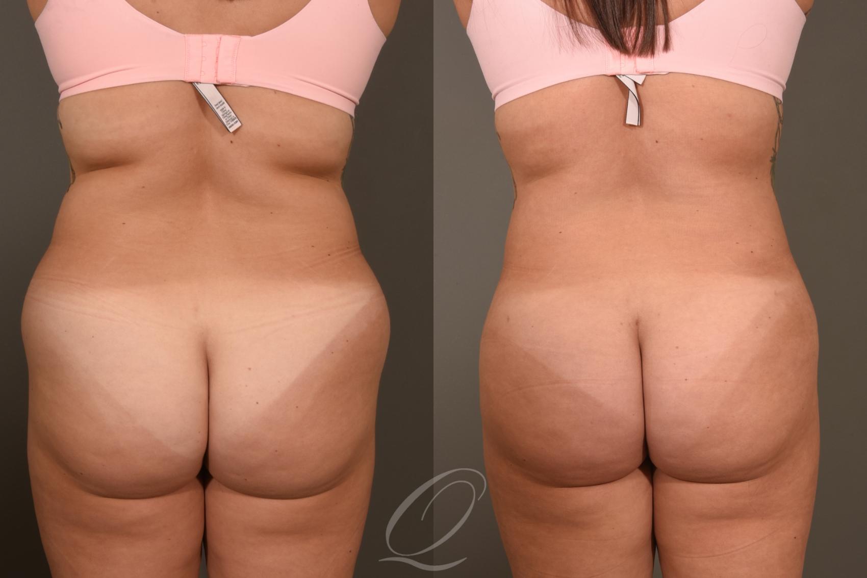 Liposuction Case 415 Before & After Back | Serving Rochester, Syracuse & Buffalo, NY | Quatela Center for Plastic Surgery