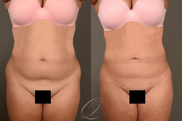 Liposuction Case 415 Before & After Front | Serving Rochester, Syracuse & Buffalo, NY | Quatela Center for Plastic Surgery