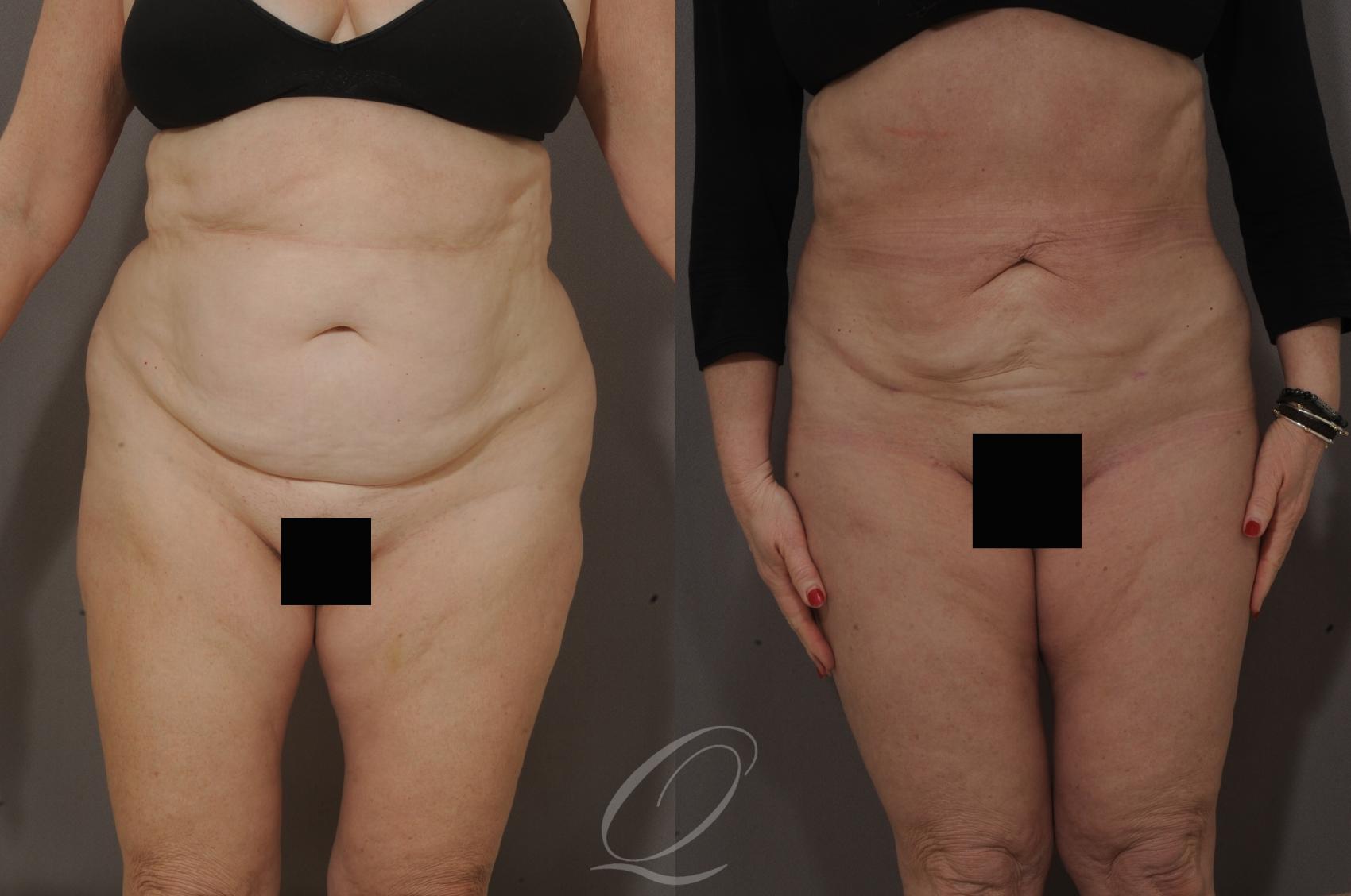 Liposuction Case 65 Before & After View #1 | Serving Rochester, Syracuse & Buffalo, NY | Quatela Center for Plastic Surgery