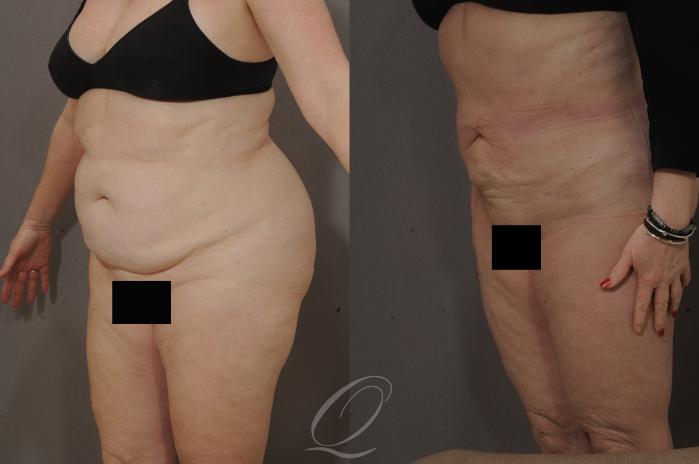 Liposuction Case 65 Before & After View #2 | Serving Rochester, Syracuse & Buffalo, NY | Quatela Center for Plastic Surgery