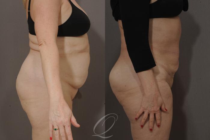 Liposuction Case 65 Before & After View #3 | Serving Rochester, Syracuse & Buffalo, NY | Quatela Center for Plastic Surgery