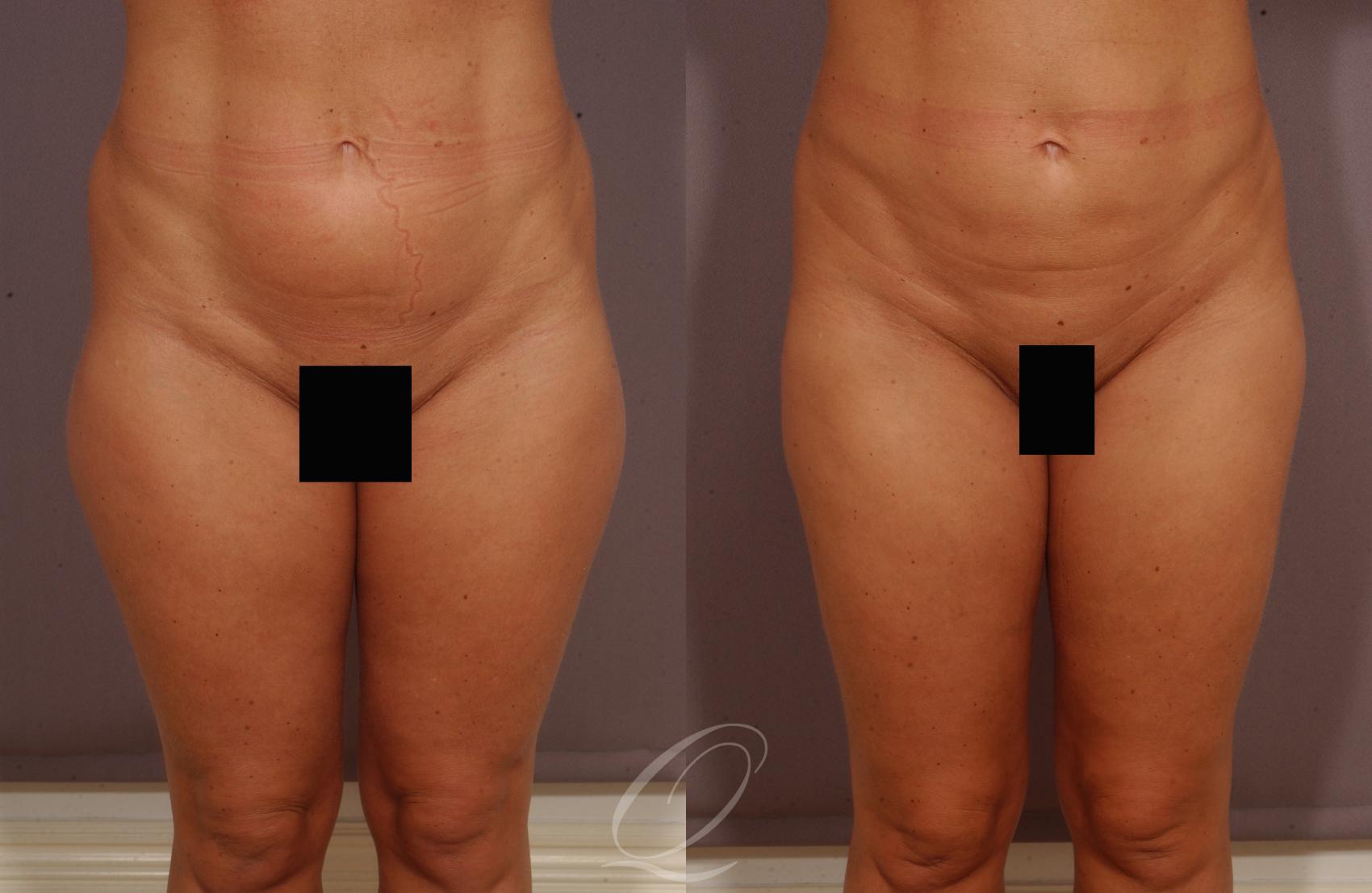 Liposuction Case 67 Before & After View #1 | Serving Rochester, Syracuse & Buffalo, NY | Quatela Center for Plastic Surgery