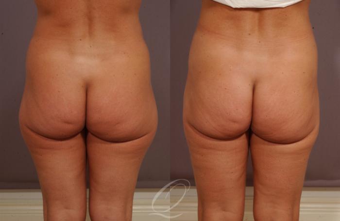 Liposuction Case 67 Before & After View #3 | Serving Rochester, Syracuse & Buffalo, NY | Quatela Center for Plastic Surgery