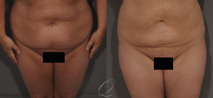 Liposuction Case 68 Before & After View #1 | Serving Rochester, Syracuse & Buffalo, NY | Quatela Center for Plastic Surgery
