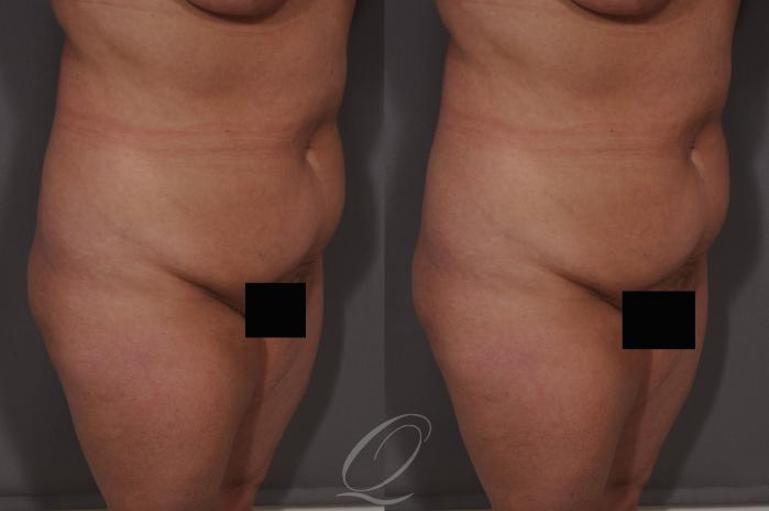 Liposuction Case 68 Before & After View #2 | Serving Rochester, Syracuse & Buffalo, NY | Quatela Center for Plastic Surgery