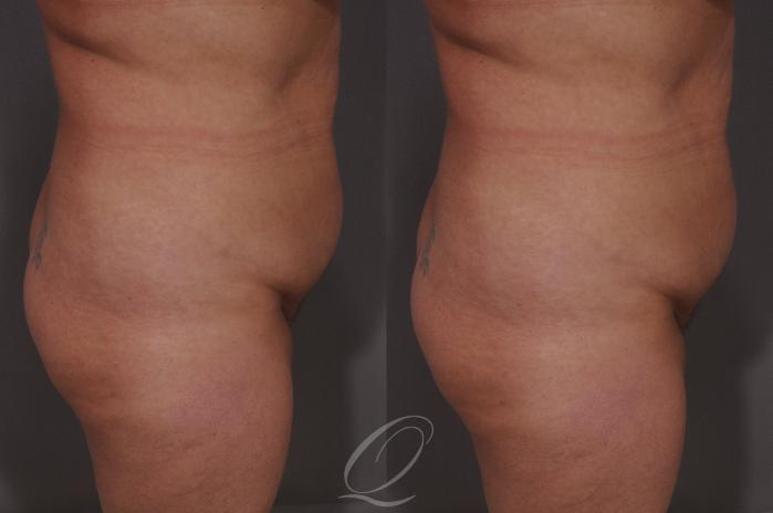 Liposuction Case 68 Before & After View #3 | Serving Rochester, Syracuse & Buffalo, NY | Quatela Center for Plastic Surgery
