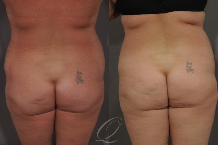 Liposuction Case 68 Before & After View #4 | Serving Rochester, Syracuse & Buffalo, NY | Quatela Center for Plastic Surgery