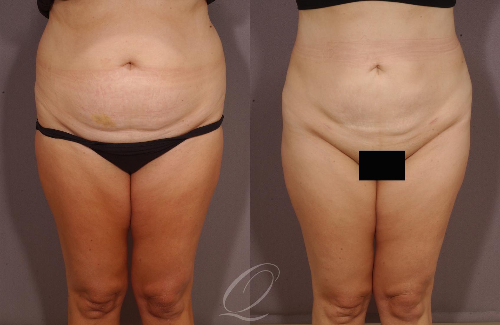 Liposuction Case 83 Before & After View #1 | Serving Rochester, Syracuse & Buffalo, NY | Quatela Center for Plastic Surgery