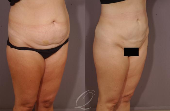 Liposuction Case 83 Before & After View #2 | Serving Rochester, Syracuse & Buffalo, NY | Quatela Center for Plastic Surgery