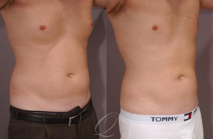 Liposuction Case 84 Before & After View #3 | Serving Rochester, Syracuse & Buffalo, NY | Quatela Center for Plastic Surgery