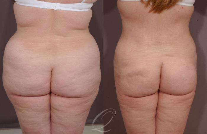 Liposuction Case 85 Before & After View #2 | Serving Rochester, Syracuse & Buffalo, NY | Quatela Center for Plastic Surgery