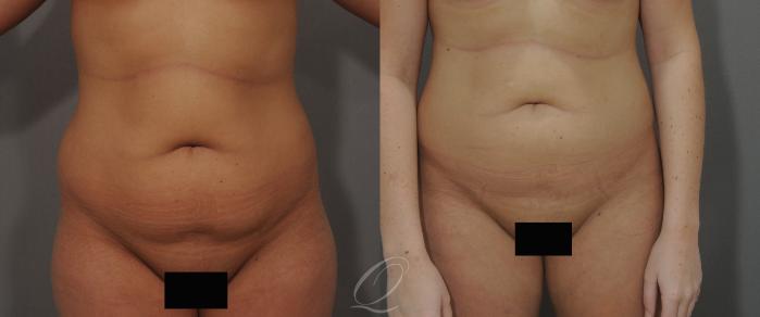 Liposuction Case 86 Before & After View #1 | Serving Rochester, Syracuse & Buffalo, NY | Quatela Center for Plastic Surgery