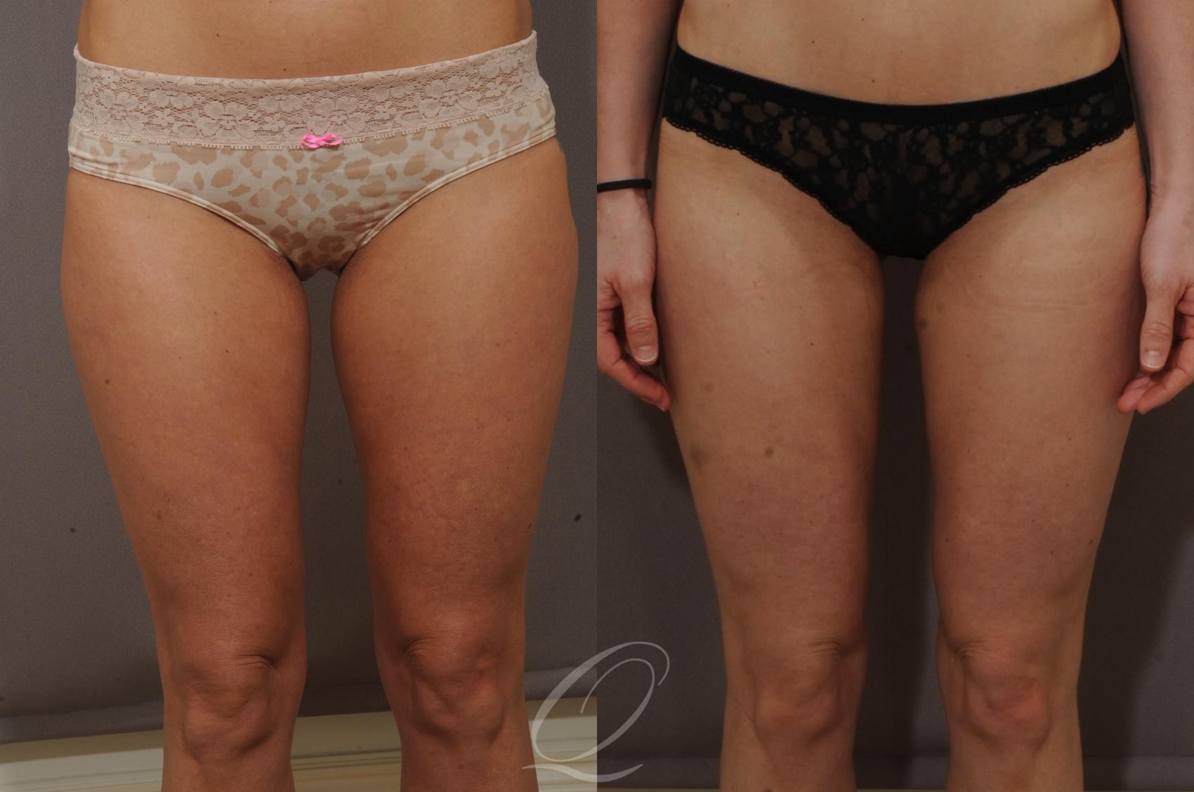 Liposuction Case 87 Before & After View #1 | Serving Rochester, Syracuse & Buffalo, NY | Quatela Center for Plastic Surgery