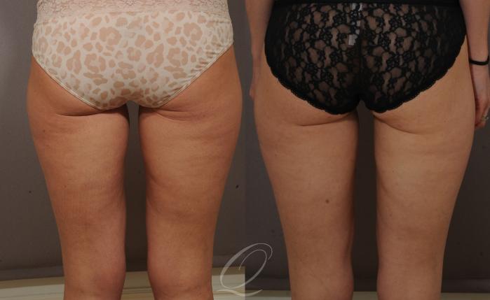 Liposuction Case 87 Before & After View #2 | Serving Rochester, Syracuse & Buffalo, NY | Quatela Center for Plastic Surgery