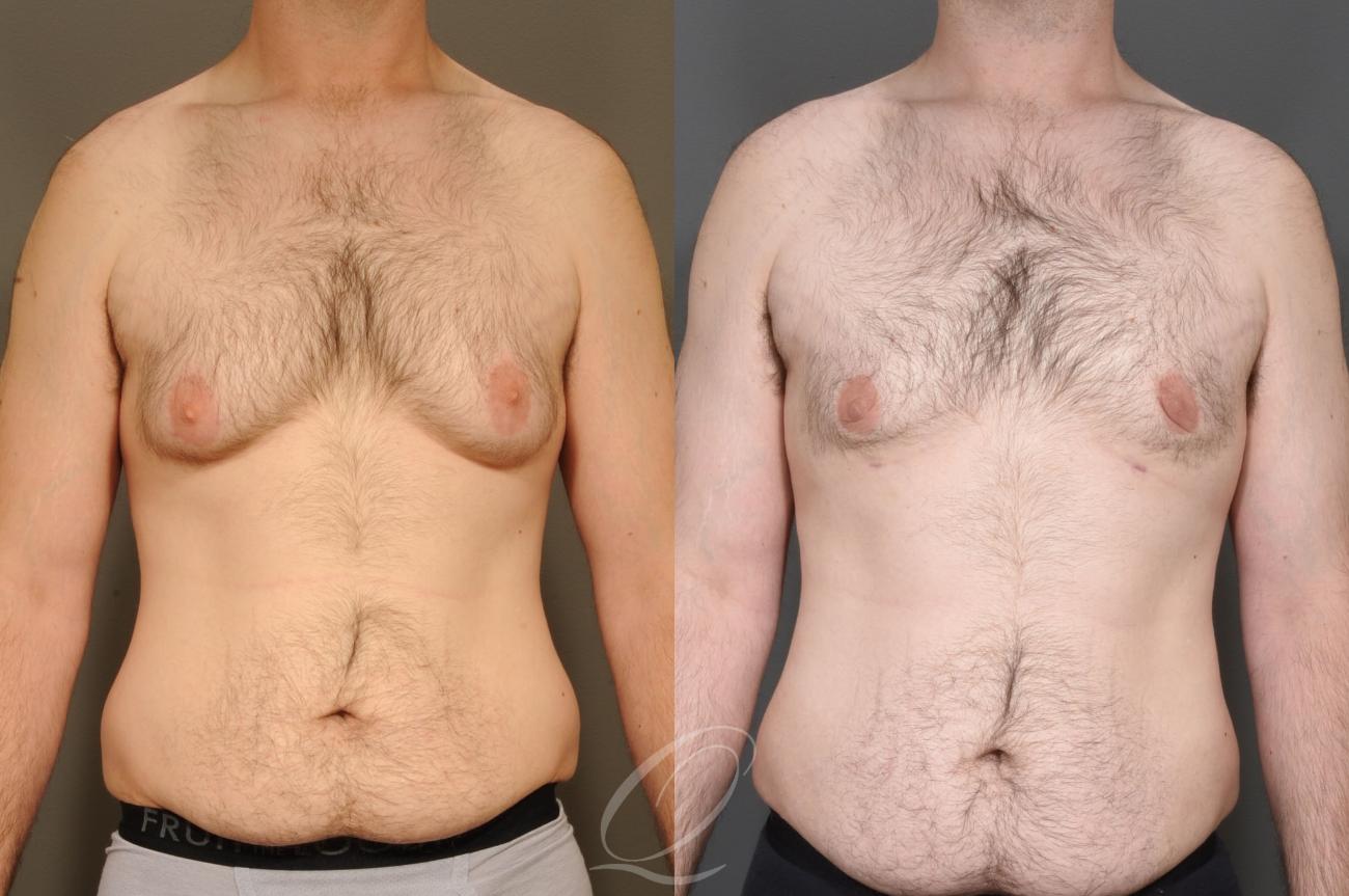 Male Breast Reduction Case 1001406 Before & After Front | Serving Rochester, Syracuse & Buffalo, NY | Quatela Center for Plastic Surgery