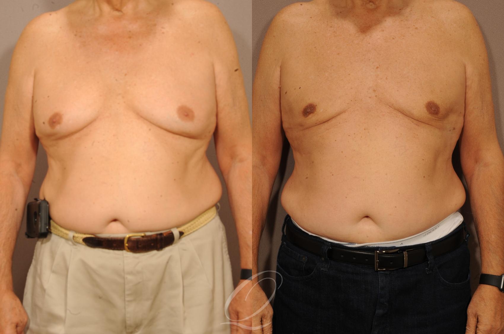 Male Breast Reduction Case 1230 Before & After View #1 | Serving Rochester, Syracuse & Buffalo, NY | Quatela Center for Plastic Surgery