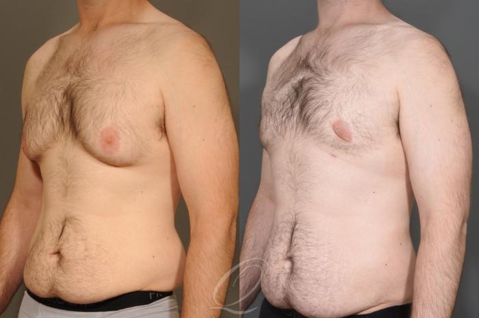 Male Breast Reduction Case 1406 Before & After Left Oblique | Serving Rochester, Syracuse & Buffalo, NY | Quatela Center for Plastic Surgery