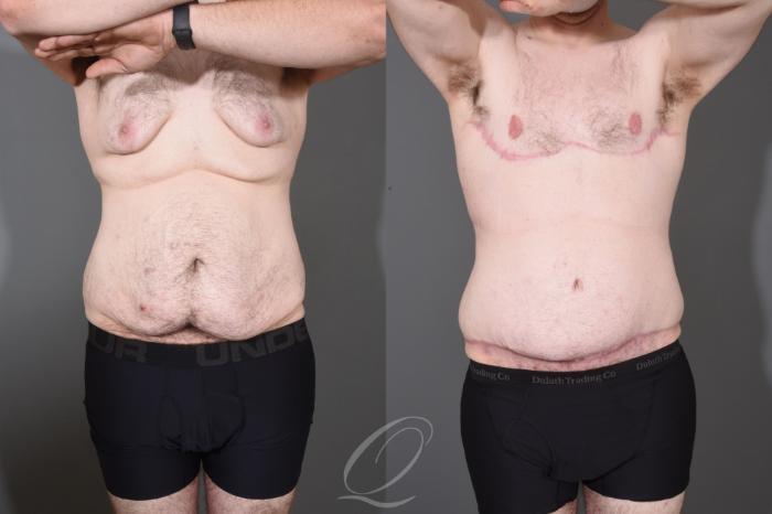 Male Breast Reduction Case 1447 Before & After Front | Serving Rochester, Syracuse & Buffalo, NY | Quatela Center for Plastic Surgery