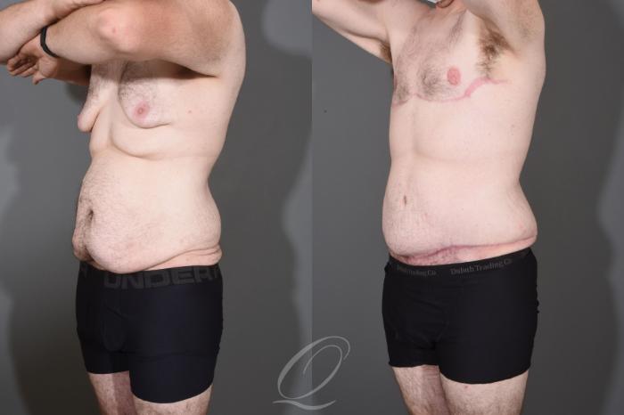 Male Tummy Tuck Case 1447 Before & After Left Oblique | Serving Rochester, Syracuse & Buffalo, NY | Quatela Center for Plastic Surgery