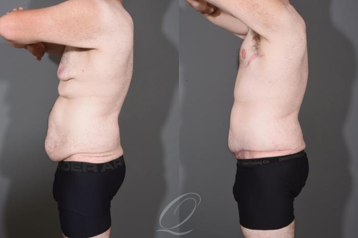 Male Tummy Tuck Case 1447 Before & After Left Side | Serving Rochester, Syracuse & Buffalo, NY | Quatela Center for Plastic Surgery
