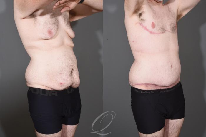 Male Breast Reduction Case 1447 Before & After Right Oblique | Serving Rochester, Syracuse & Buffalo, NY | Quatela Center for Plastic Surgery