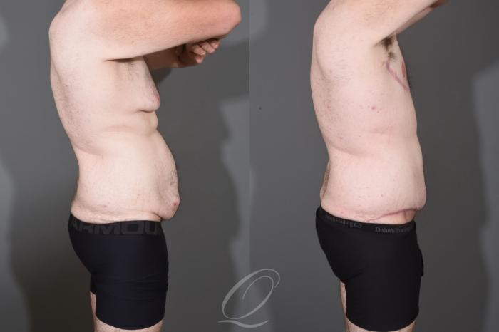 Male Tummy Tuck Case 1447 Before & After Right Side | Serving Rochester, Syracuse & Buffalo, NY | Quatela Center for Plastic Surgery