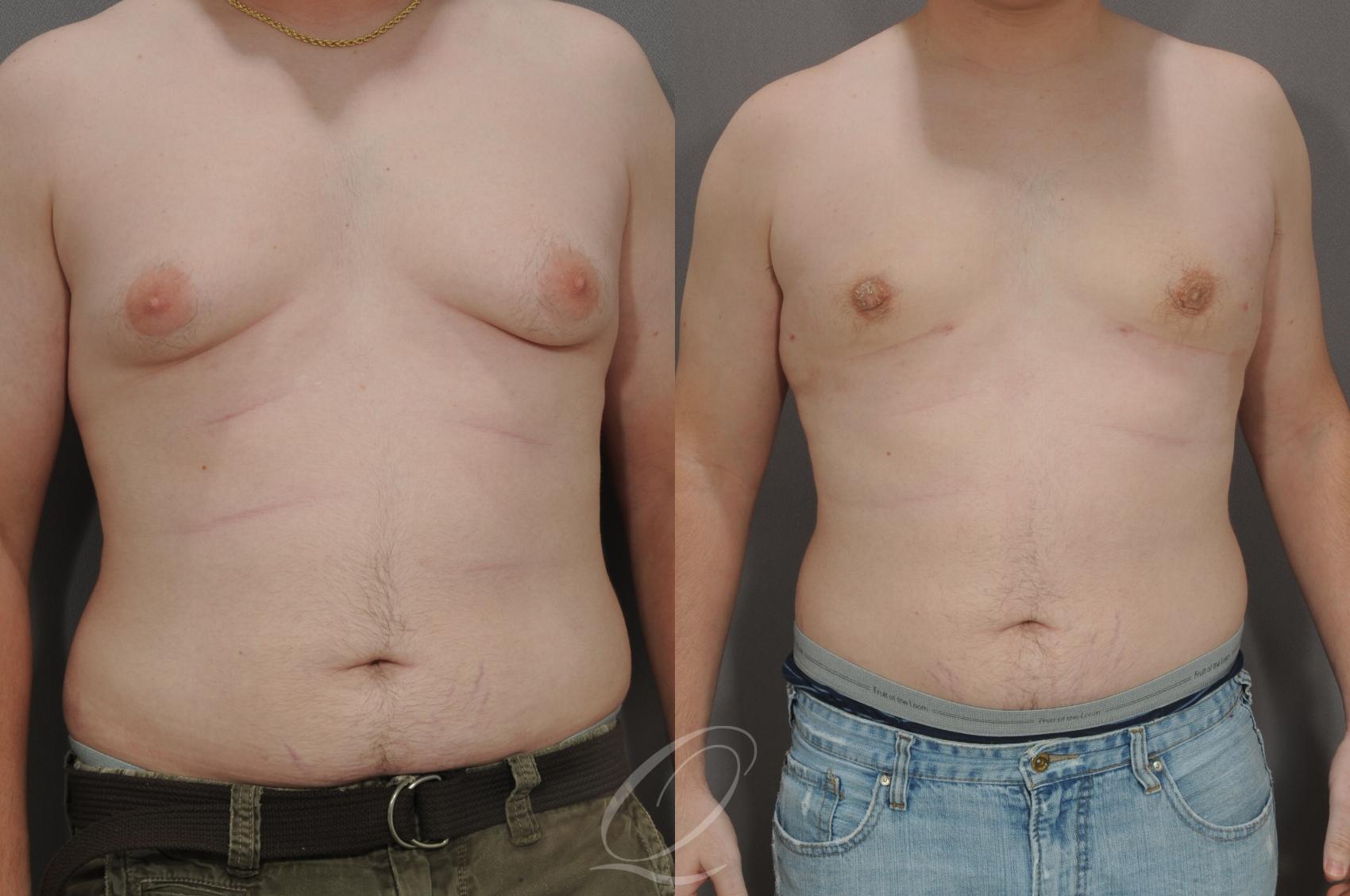 Male Breast Reduction Case 185 Before & After View #1 | Serving Rochester, Syracuse & Buffalo, NY | Quatela Center for Plastic Surgery