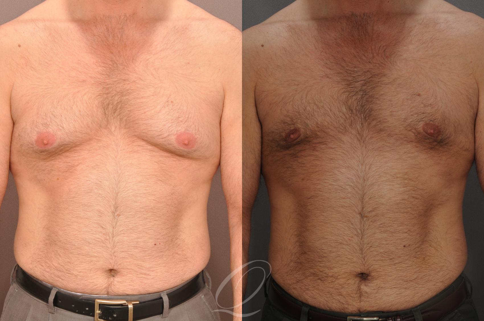 Male Breast Reduction Case 186 Before & After View #1 | Serving Rochester, Syracuse & Buffalo, NY | Quatela Center for Plastic Surgery