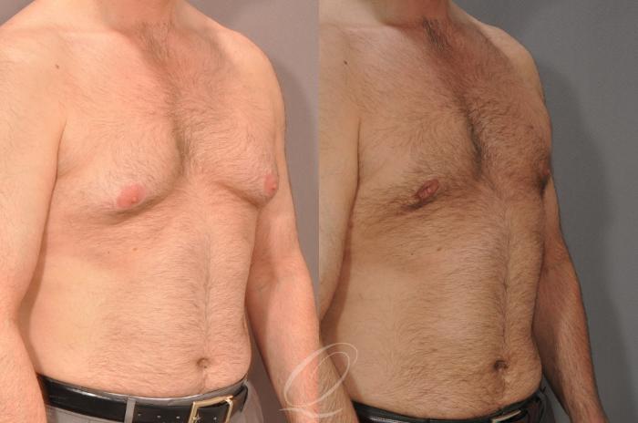 Male Breast Reduction Case 186 Before & After View #2 | Serving Rochester, Syracuse & Buffalo, NY | Quatela Center for Plastic Surgery