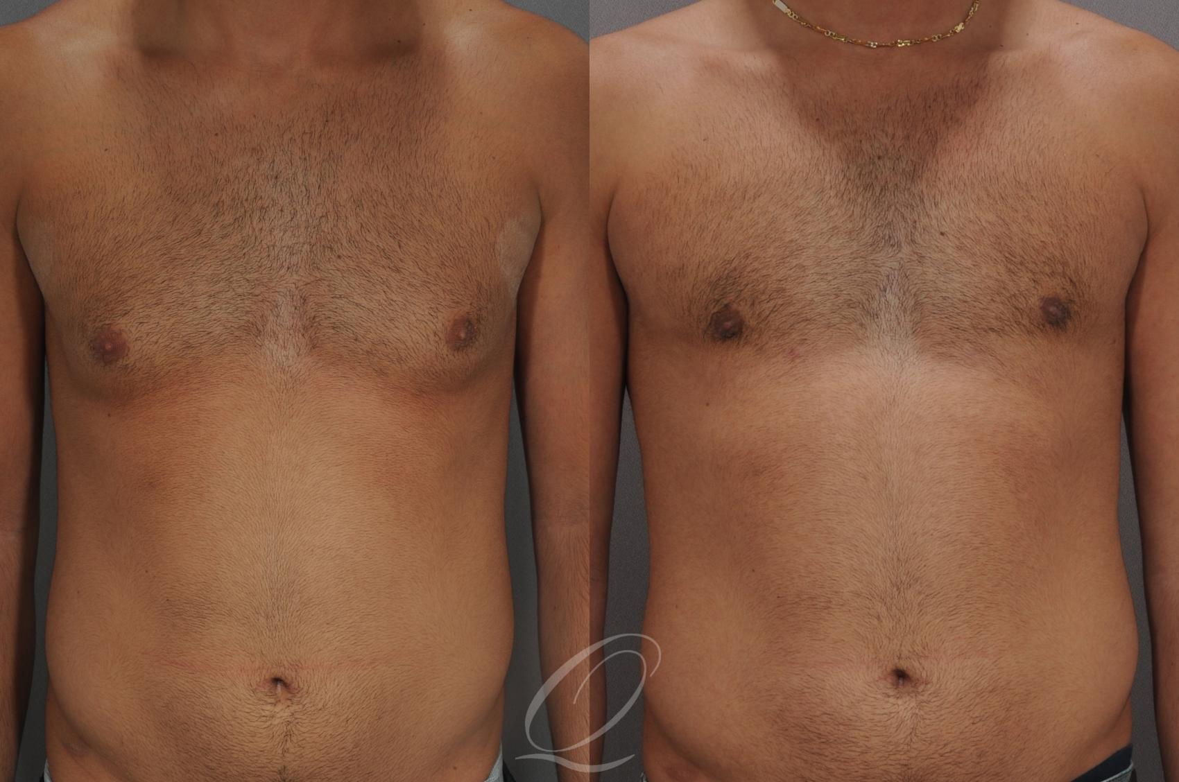 Male Breast Reduction Case 187 Before & After View #1 | Serving Rochester, Syracuse & Buffalo, NY | Quatela Center for Plastic Surgery