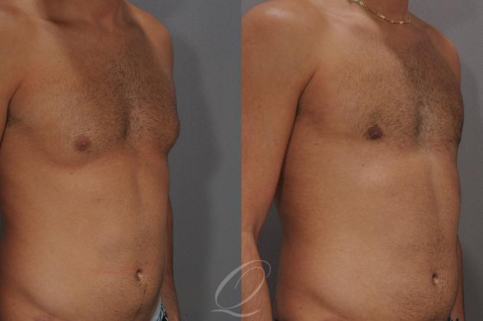 Male Breast Reduction Case 187 Before & After View #2 | Serving Rochester, Syracuse & Buffalo, NY | Quatela Center for Plastic Surgery