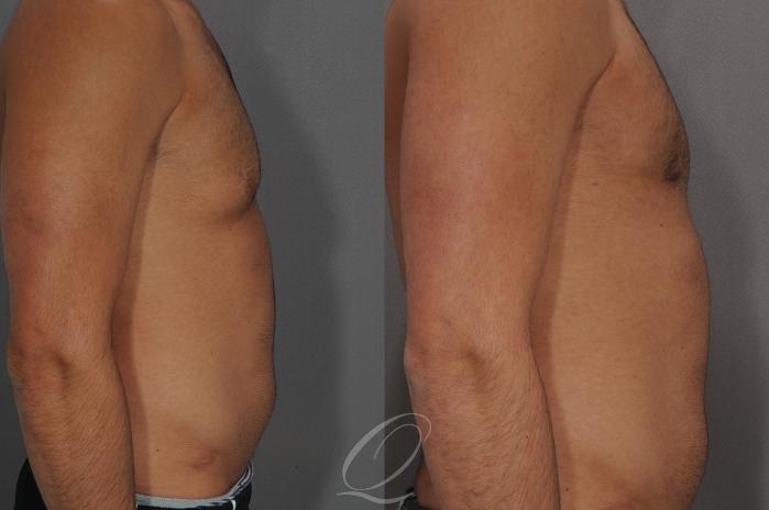 Male Breast Reduction Case 187 Before & After View #3 | Serving Rochester, Syracuse & Buffalo, NY | Quatela Center for Plastic Surgery