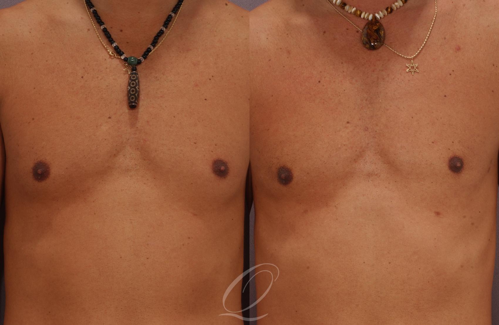 Male Breast Reduction Case 188 Before & After View #1 | Serving Rochester, Syracuse & Buffalo, NY | Quatela Center for Plastic Surgery