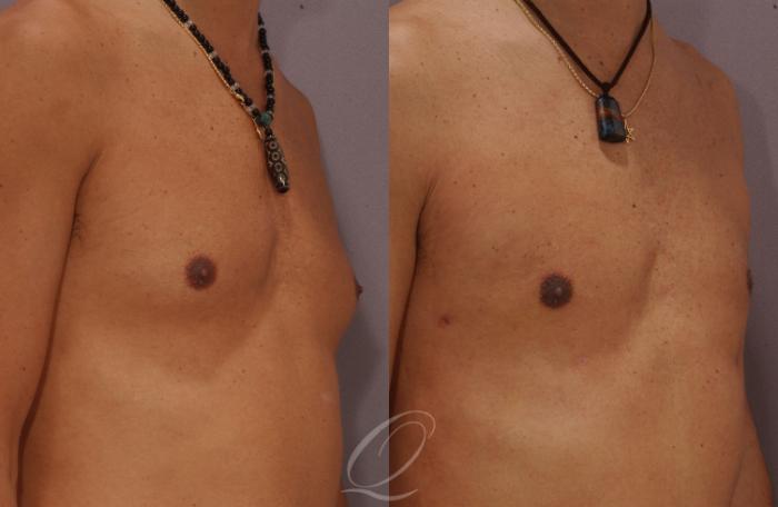 Male Breast Reduction Case 188 Before & After View #2 | Serving Rochester, Syracuse & Buffalo, NY | Quatela Center for Plastic Surgery