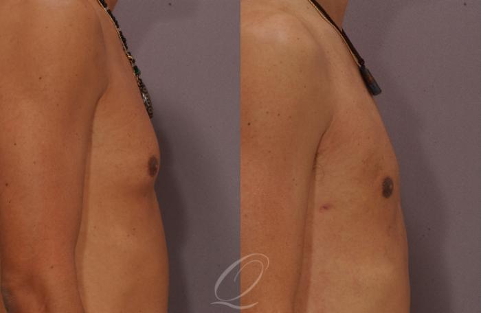Male Breast Reduction Case 188 Before & After View #3 | Serving Rochester, Syracuse & Buffalo, NY | Quatela Center for Plastic Surgery