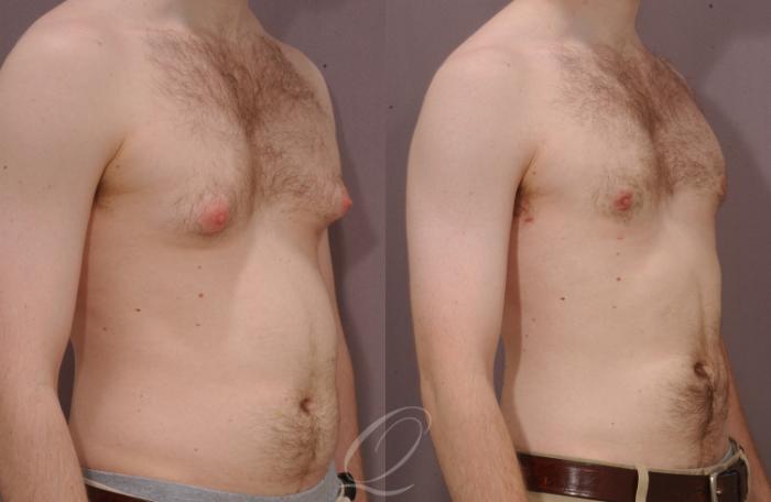 Male Breast Reduction Case 189 Before & After View #2 | Serving Rochester, Syracuse & Buffalo, NY | Quatela Center for Plastic Surgery