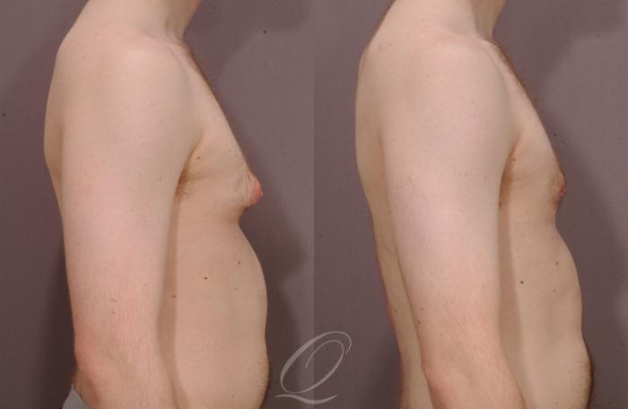 Male Breast Reduction Case 189 Before & After View #3 | Serving Rochester, Syracuse & Buffalo, NY | Quatela Center for Plastic Surgery