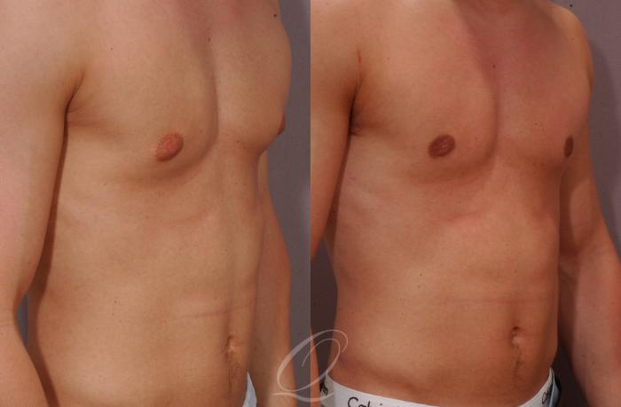 Male Breast Reduction Case 190 Before & After View #2 | Serving Rochester, Syracuse & Buffalo, NY | Quatela Center for Plastic Surgery