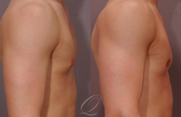 Male Breast Reduction Case 190 Before & After View #3 | Serving Rochester, Syracuse & Buffalo, NY | Quatela Center for Plastic Surgery