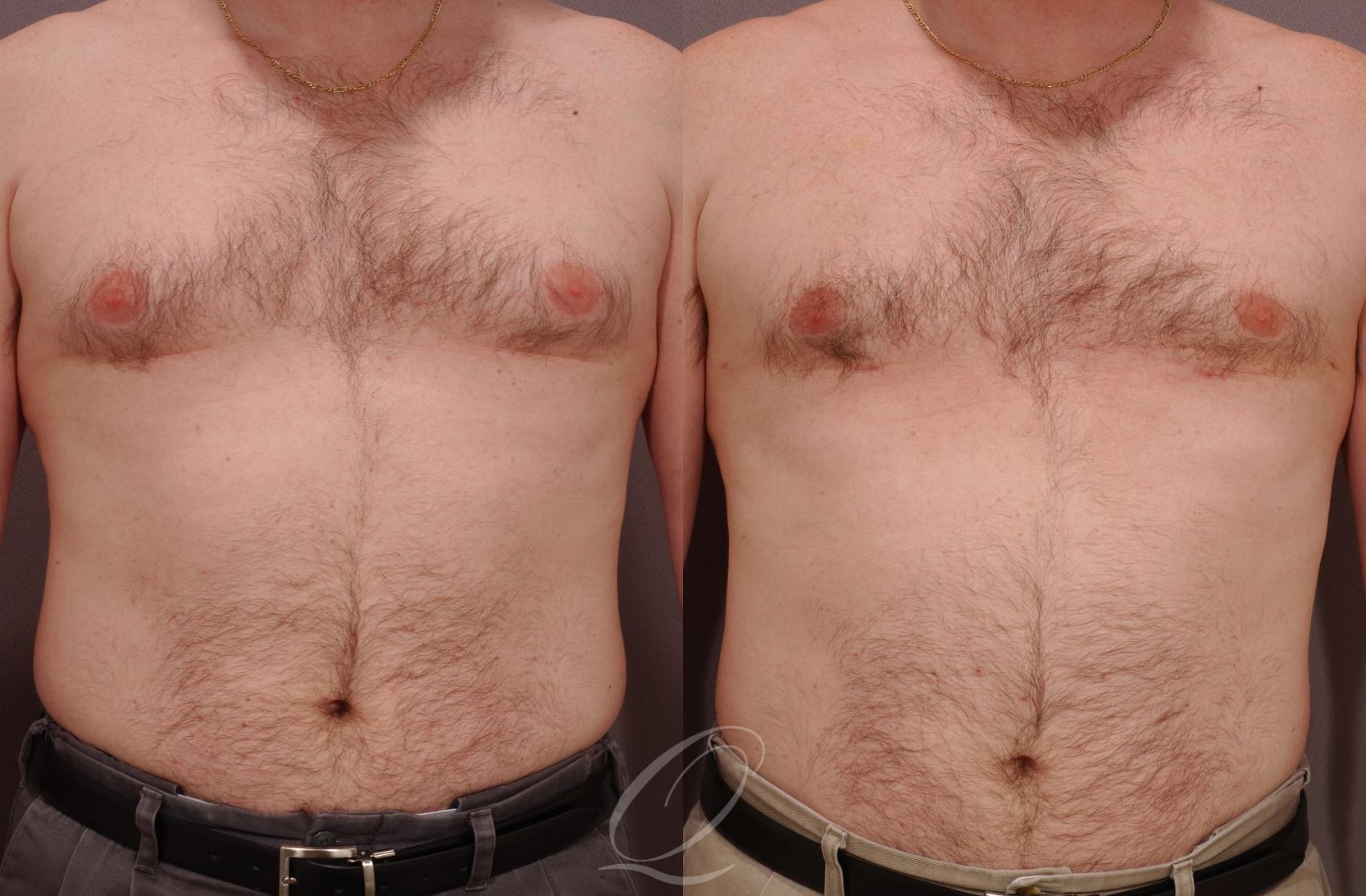 Male Breast Reduction Case 191 Before & After View #1 | Serving Rochester, Syracuse & Buffalo, NY | Quatela Center for Plastic Surgery