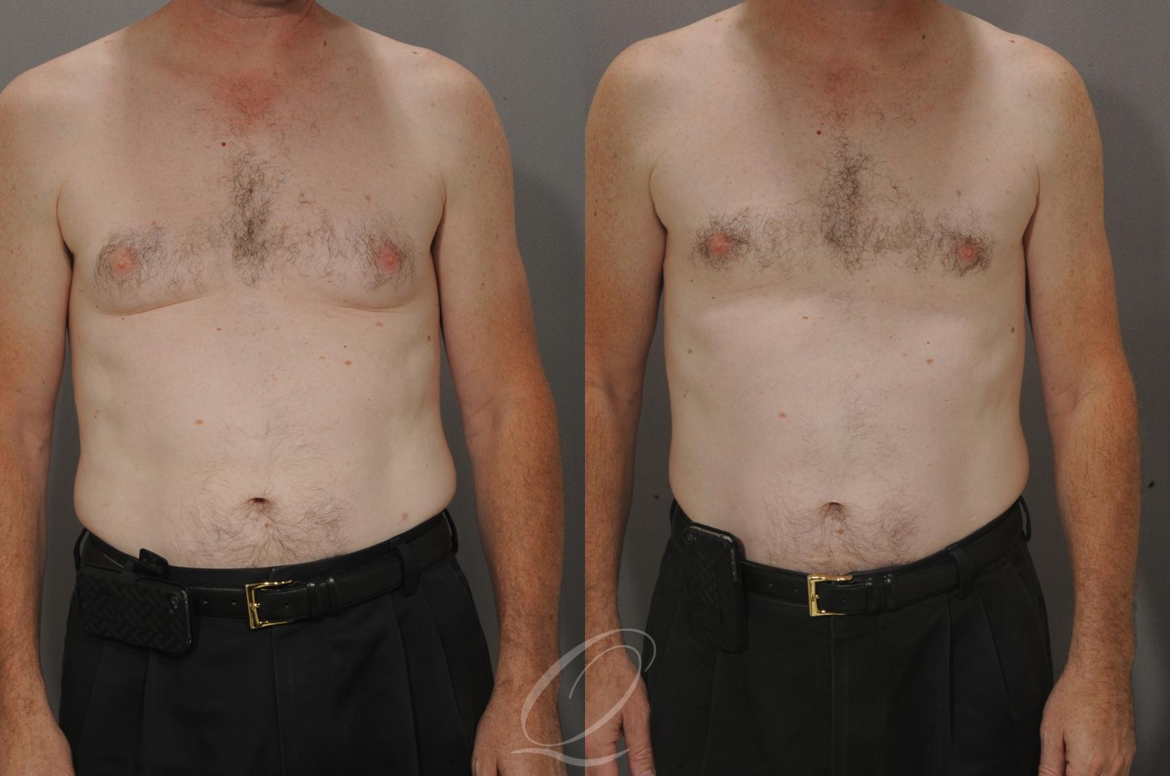 Male Breast Reduction Case 192 Before & After View #1 | Serving Rochester, Syracuse & Buffalo, NY | Quatela Center for Plastic Surgery
