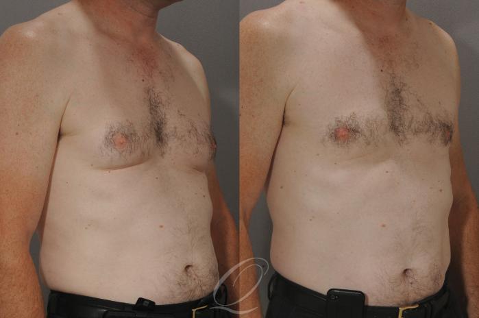 Male Breast Reduction Case 192 Before & After View #2 | Serving Rochester, Syracuse & Buffalo, NY | Quatela Center for Plastic Surgery