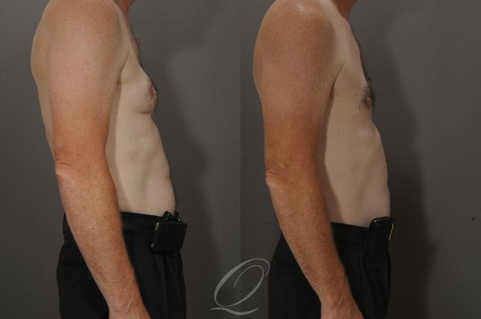 Male Breast Reduction Case 192 Before & After View #3 | Serving Rochester, Syracuse & Buffalo, NY | Quatela Center for Plastic Surgery