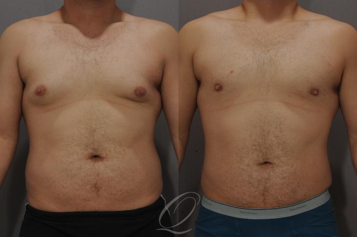 Male Breast Reduction Case 193 Before & After View #1 | Serving Rochester, Syracuse & Buffalo, NY | Quatela Center for Plastic Surgery