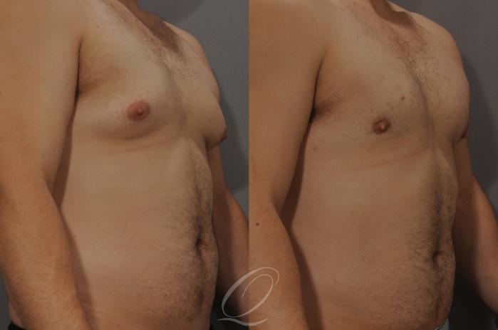 Male Breast Reduction Case 193 Before & After View #2 | Serving Rochester, Syracuse & Buffalo, NY | Quatela Center for Plastic Surgery