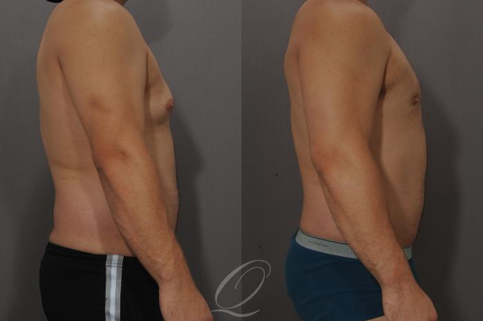 Male Breast Reduction Case 193 Before & After View #3 | Serving Rochester, Syracuse & Buffalo, NY | Quatela Center for Plastic Surgery
