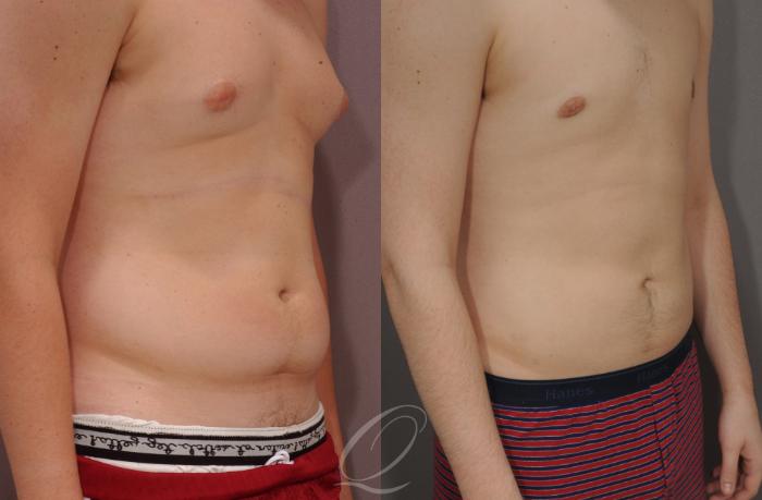 Male Breast Reduction Case 194 Before & After View #2 | Serving Rochester, Syracuse & Buffalo, NY | Quatela Center for Plastic Surgery