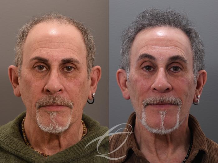 Male Facelift Case 1002045 Before & After Front | Serving Rochester, Syracuse & Buffalo, NY | Quatela Center for Plastic Surgery
